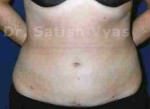 Liposuction Tummy and Back