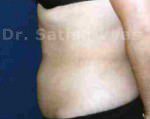Liposuction Tummy and Back