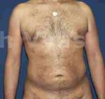 Liposuction Tummy and Back