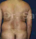 Liposuction Tummy and Back