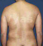 Liposuction Tummy and Back