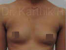 Breast Implants (Breast Augmentation)