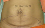 Tummy Tuck