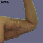 Liposuction Arms and Arm Tuck