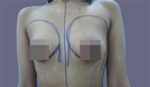 Breast Fat Fill (Breast Augmentation)