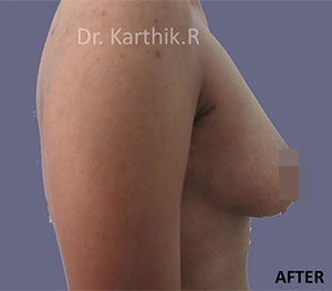 Breast Fat Fill (Breast Augmentation)