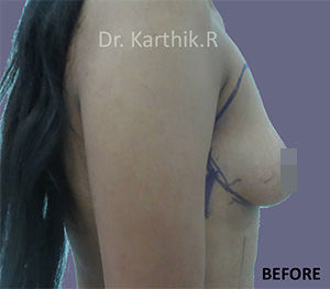 Breast Fat Fill (Breast Augmentation)
