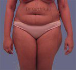 Liposuction Tummy and Back