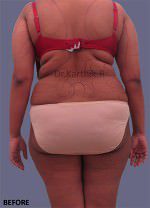 Liposuction Tummy and Back