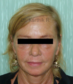 Non Surgical Face Lift