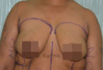 Breast Fat Fill (Breast Augmentation)