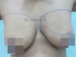 Breast Fat Fill (Breast Augmentation)