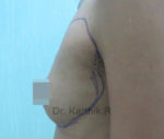 Breast Fat Fill (Breast Augmentation)