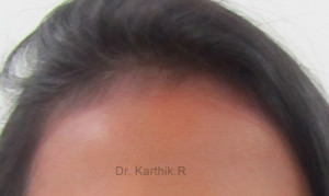 Female Hair Transplant