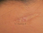 Scar Revision