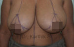 Breast Reduction and Breast Lift