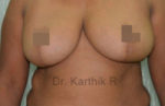 Breast Reduction and Breast Lift