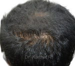 Dermaroller scalp