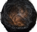 Dermaroller scalp
