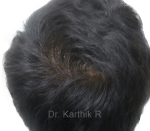 Dermaroller scalp