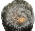 Dermaroller scalp