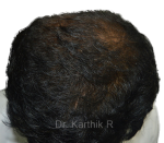 Dermaroller scalp