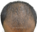 Dermaroller scalp