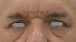 Blepharoplasty