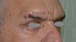 Blepharoplasty
