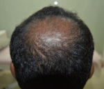Dermaroller scalp