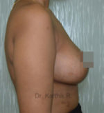 Breast Reduction and Breast Lift