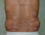 Multiple Lipoma