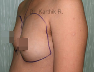 Breast Implants (Breast Augmentation)