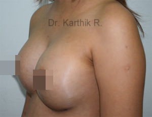 Breast Implants (Breast Augmentation)