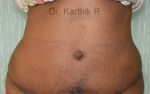 Tummy Tuck