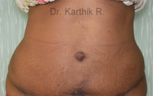 Tummy Tuck