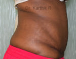 Tummy Tuck