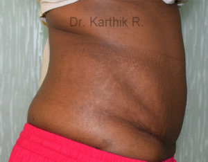 Tummy Tuck