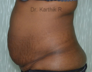 Tummy Tuck
