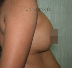 Breast Implants (Breast Augmentation)