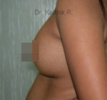 Breast Implants (Breast Augmentation)