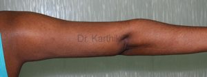 Liposuction Arms and Arm Tuck