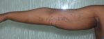 Liposuction Arms and Arm Tuck