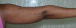 Liposuction Arms and Arm Tuck