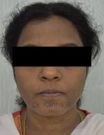 Chemical Peels & Microdermabrasion