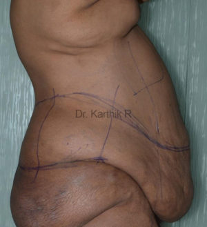 Circumferential Body Lift