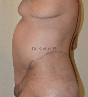 Circumferential Body Lift