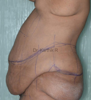 Circumferential Body Lift