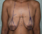 Breast Reduction and Breast Lift