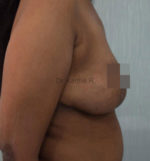 Breast Reduction and Breast Lift